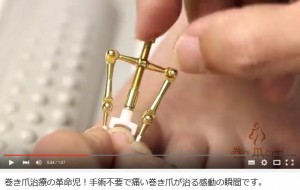 巻き爪動画